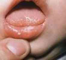 Čireve u ustima: uzroke. liječenje
