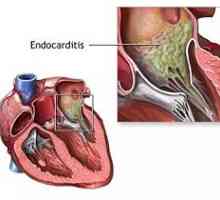 Endokarditis