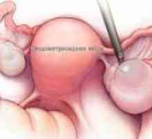 Endometrioid jajnika ciste - uzroci, simptomi, liječenje
