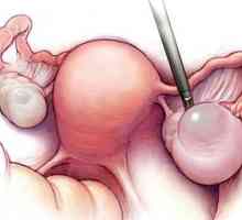 Endometrioid cista jajnika