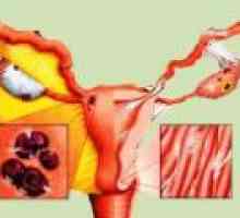 Endometrioza: simptomi, znakovi, liječenje