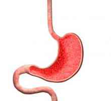 Erozivni gastritis