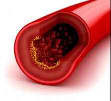 Kako brzo smanjiti kolesterol narodnih lijekova