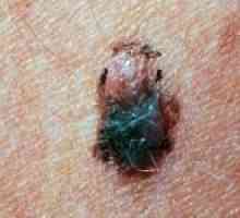 Kako da se oporavi od melanoma