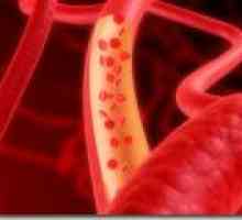 Kako očistiti i izliječiti krvne žile?