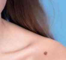Kako prepoznati i izliječiti melanom kože