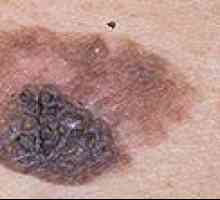 Kako bi se utvrdilo postojanje melanoma i njegova lijeku