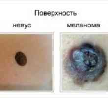 Kako razlikovati melanom iz Nevi