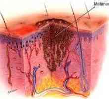 Kako je diferencijalna dijagnoza melanoma