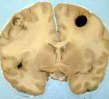 Kako prepoznati i liječiti melanoma mozga