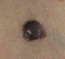 Nodularni melanom izgleda i što značajke ga liječiti