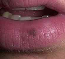 Kako dijagnosticirati i liječiti melanom na usni