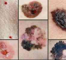 Koje značajke obilježavaju razvoj melanoma i kako instalirati prognozu