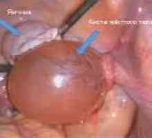 Korpus luteum cista u trudnoći, uzroci, liječenje