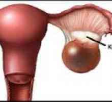 Cystoma (desno, lijevo) jajnika - uzroci, liječenje