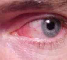 Konjunktivitis ili crvene oči: simptomi, liječenje