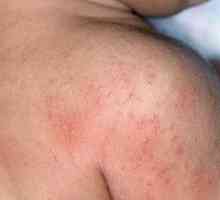 Alergija kože: uzroci, simptomi, liječenje