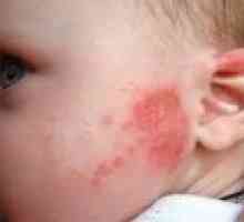 Crvene mrlje na koži djeteta - uzroci, liječenje