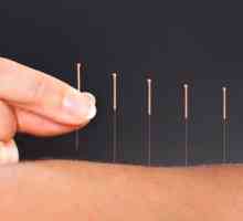 Akupunktura: Istine i mitovi