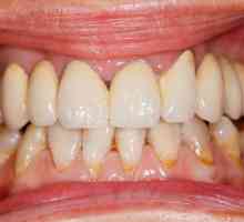 Liječenje parodontnih narodnih bolesti lijekova: najučinkovitije metode