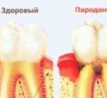 Liječenje parodontnih bolesti kod kuće