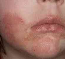 Tretman seboroičnog dermatitisa na licu