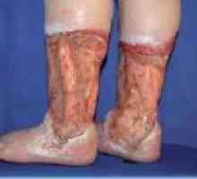 Liječenje venozni ulkusi na nogama