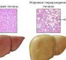 Tretman masne jetre