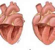 Plućna bolest srca: uzroci, simptomi, liječenje