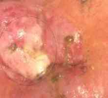 Cervikalnih leukoplakije: simptomi, uzroci i liječenje