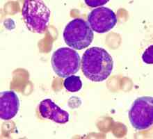 Leukemijom: Simptomi i liječenje