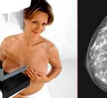 Mamografija dojke