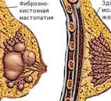 Cistična bolest dojke - uzroci, simptomi i liječenje
