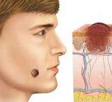 Melanom glave: lokalizacija, razvoj, dijagnoza i liječenje