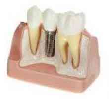 Metode dentalnih implantata