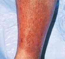 Metode za liječenje i prevenciju proširenih dermatitisa