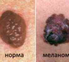 Metode koje se koriste za tretiranje melanoma