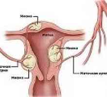 Fibroidi maternice tijekom trudnoće, uzroci, liječenje