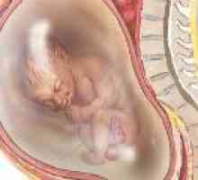 Hidramnion u trudnoći, uzroci, posljedice