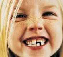 Malokluzija zuba