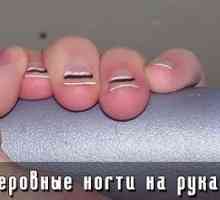 Nazubljeni nokti