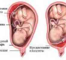 Niska placentacije tijekom trudnoće, što je to?