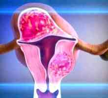 Kirurgija za uklanjanje fibroids maternice