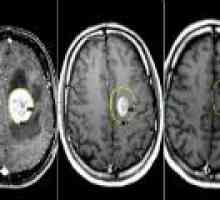 Brain Tumor - uzroci, simptomi, liječenje