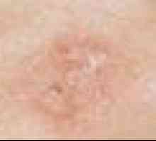 Glavna karakteristika melanom i postupci za liječenje