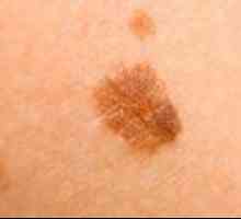 Ključne značajke i metode liječenja multiple melanoma