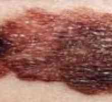Značajke i liječenje rasprostranjenih oblika melanoma