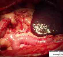 Značajke postoperativnom razdoblju nakon uklanjanja debelog crijeva i tumora
