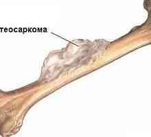 Osteosarkom (osteogenog sarkom) - uzroci, simptomi, dijagnoza i liječenje