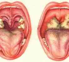 Strep grlo - simptomi i liječenje akutne ždrijela